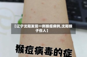 【辽宁沈阳发现一例猴痘病例,沈阳猴子伤人】